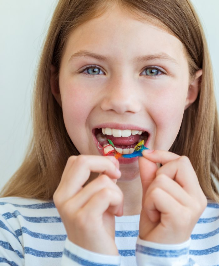 Несъемный аппарат для расширения верхней челюсти